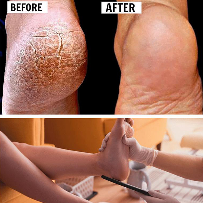 FootFile, vrhunska ročna pila za pedikuro - Image 7